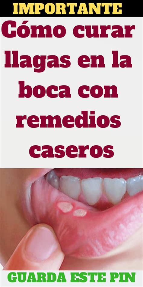 mucha leche en la boca|Cómo curar llagas en la boca: por qué salen y cómo curarlas.